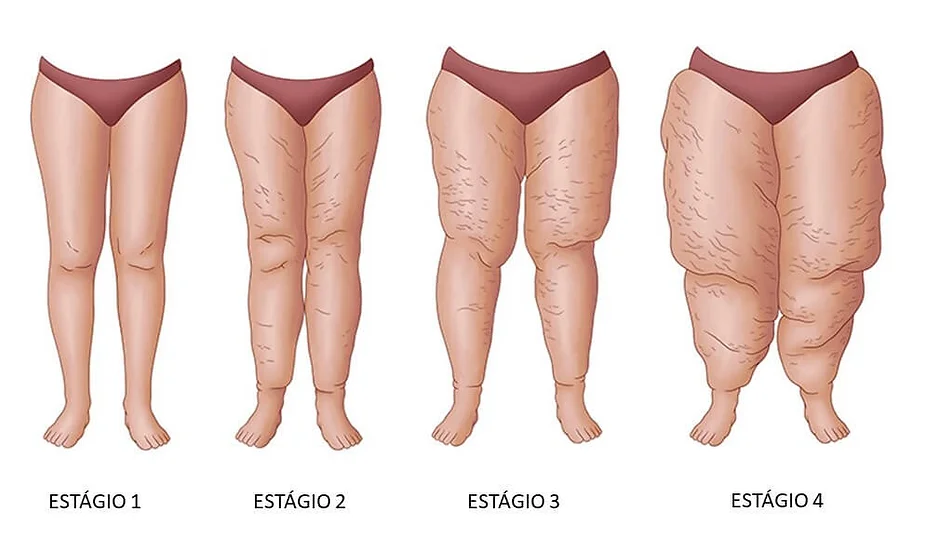 lipedema Tudo o que você Precisa Saber sobre Lipedema: O que é e Como Tratar?