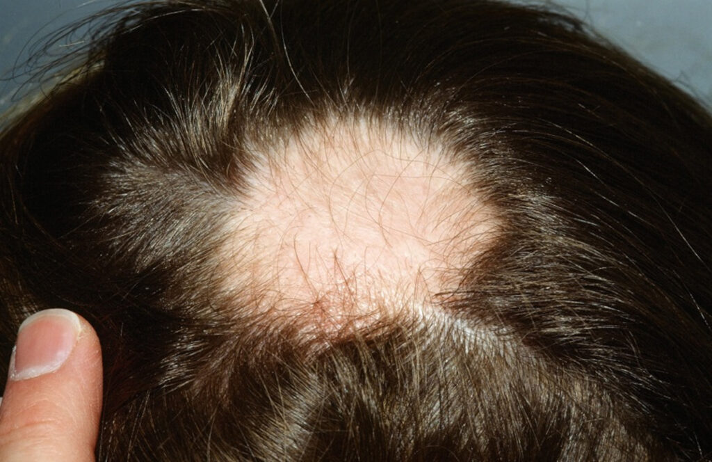 alopecia_areata-1024x664 O que é Alopécia Areata? Causas, Sintomas e Tratamentos Atualizados