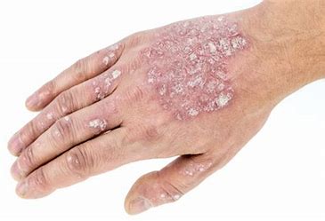 psoriase Psoríase: O Que É, Sintomas, Diagnóstico e Tratamentos