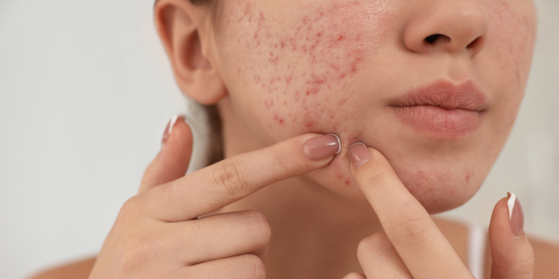 Design-sem-nome-59 5 Dicas de Como Tratar Manchas de Acne
