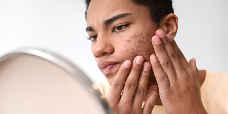 Design-sem-nome-60 5 Dicas de Como Tratar Manchas de Acne